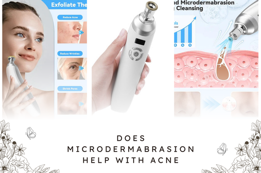 Does Microdermabrasion Help With Acne