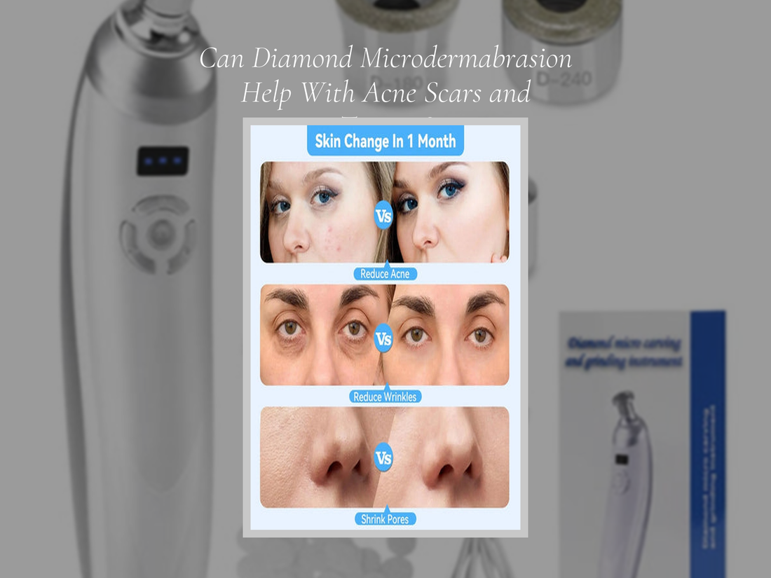 Can Diamond Microdermabrasion Help With Acne Scars and Texture?