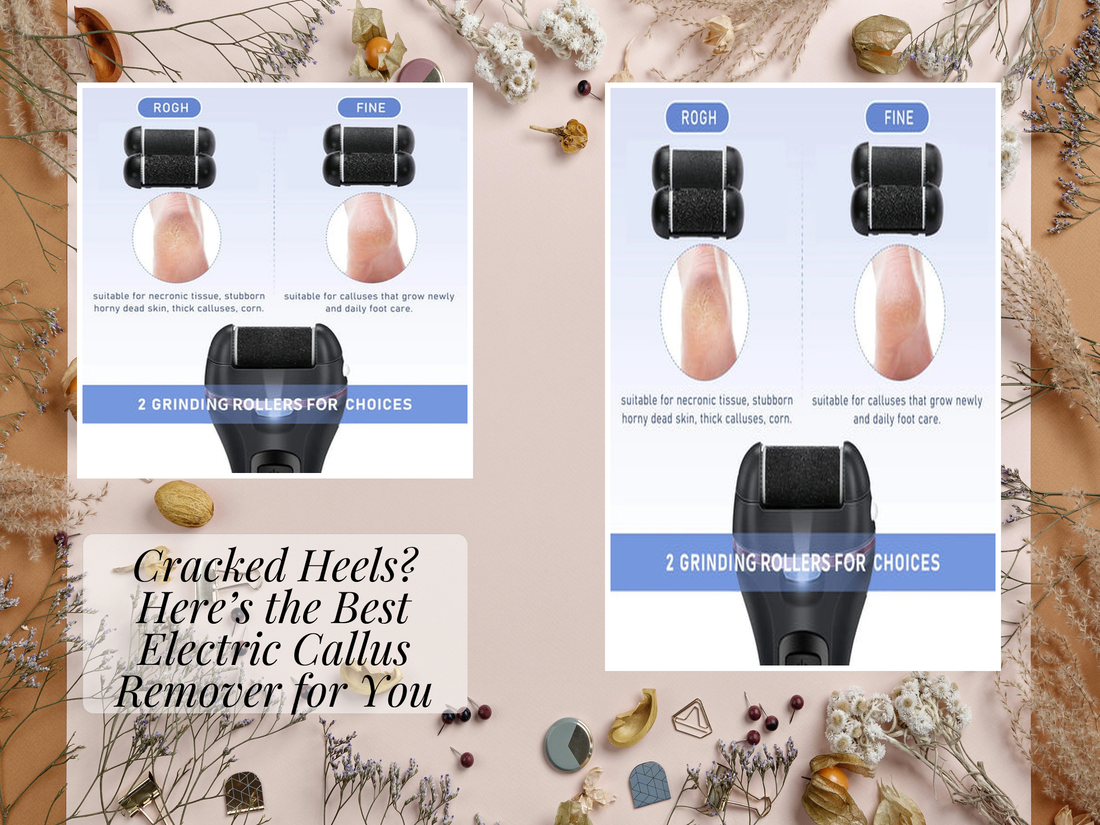 Cracked Heels? Here’s the Best Electric Callus Remover for You