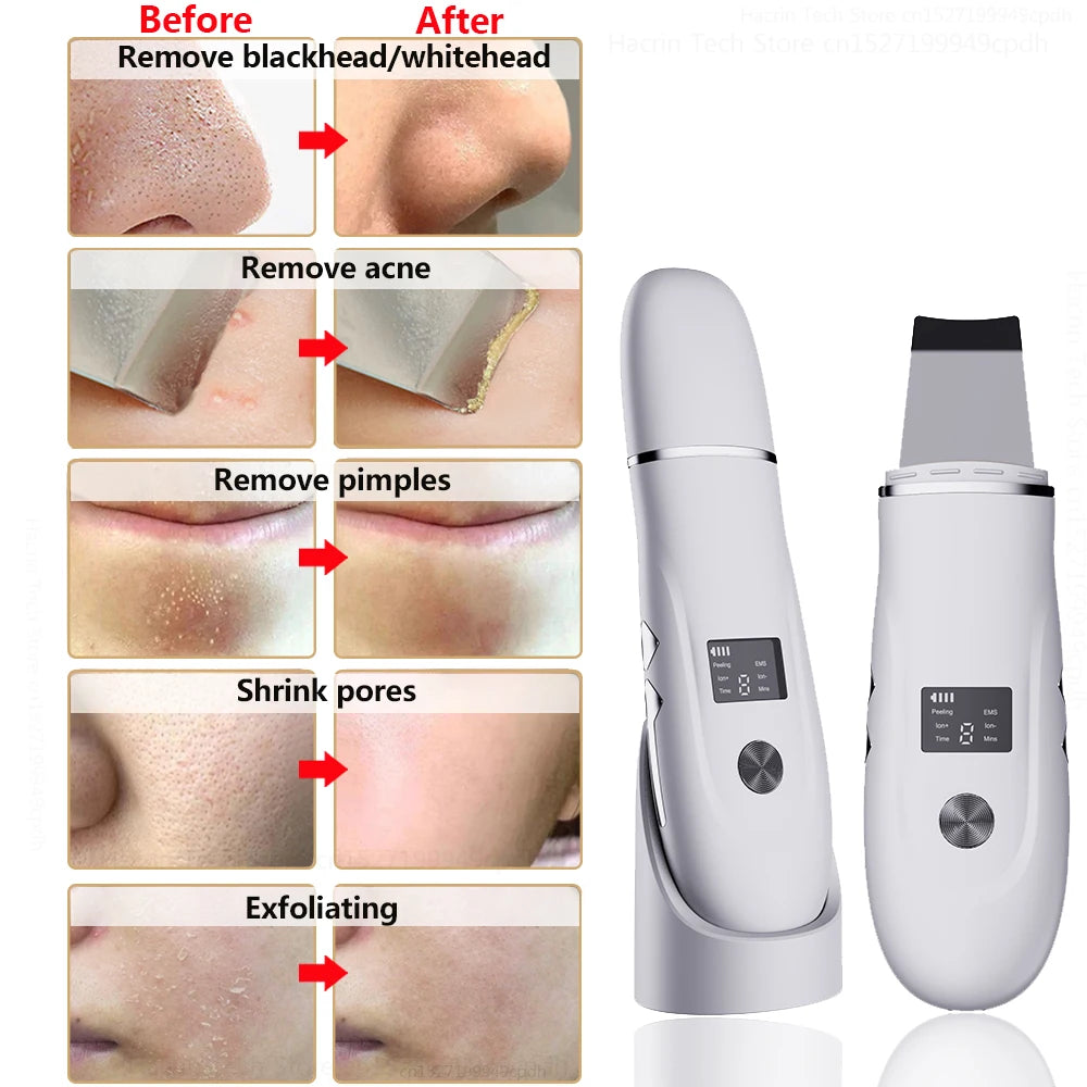 KentDO™ Ultrasonic Face Scrubber – Deep Pore Cleansing