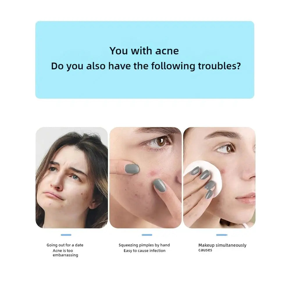 KentDO™ Hydrocolloid Acne Patches – Fast Spot Healing