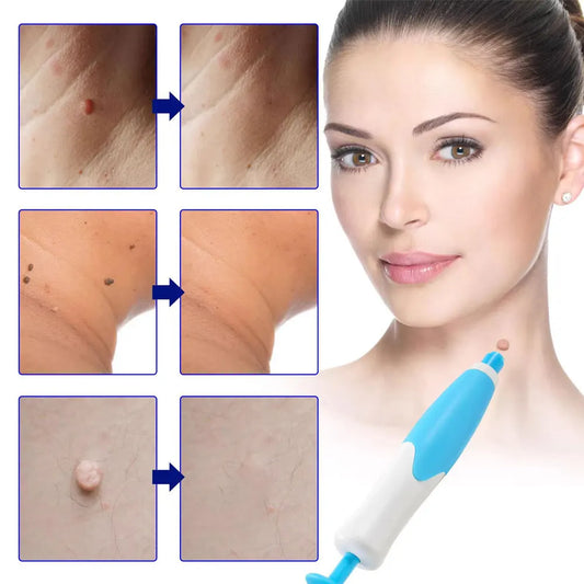 KentDO™ Double Head Wart Remover Pen – Safe Skin Tag Removal