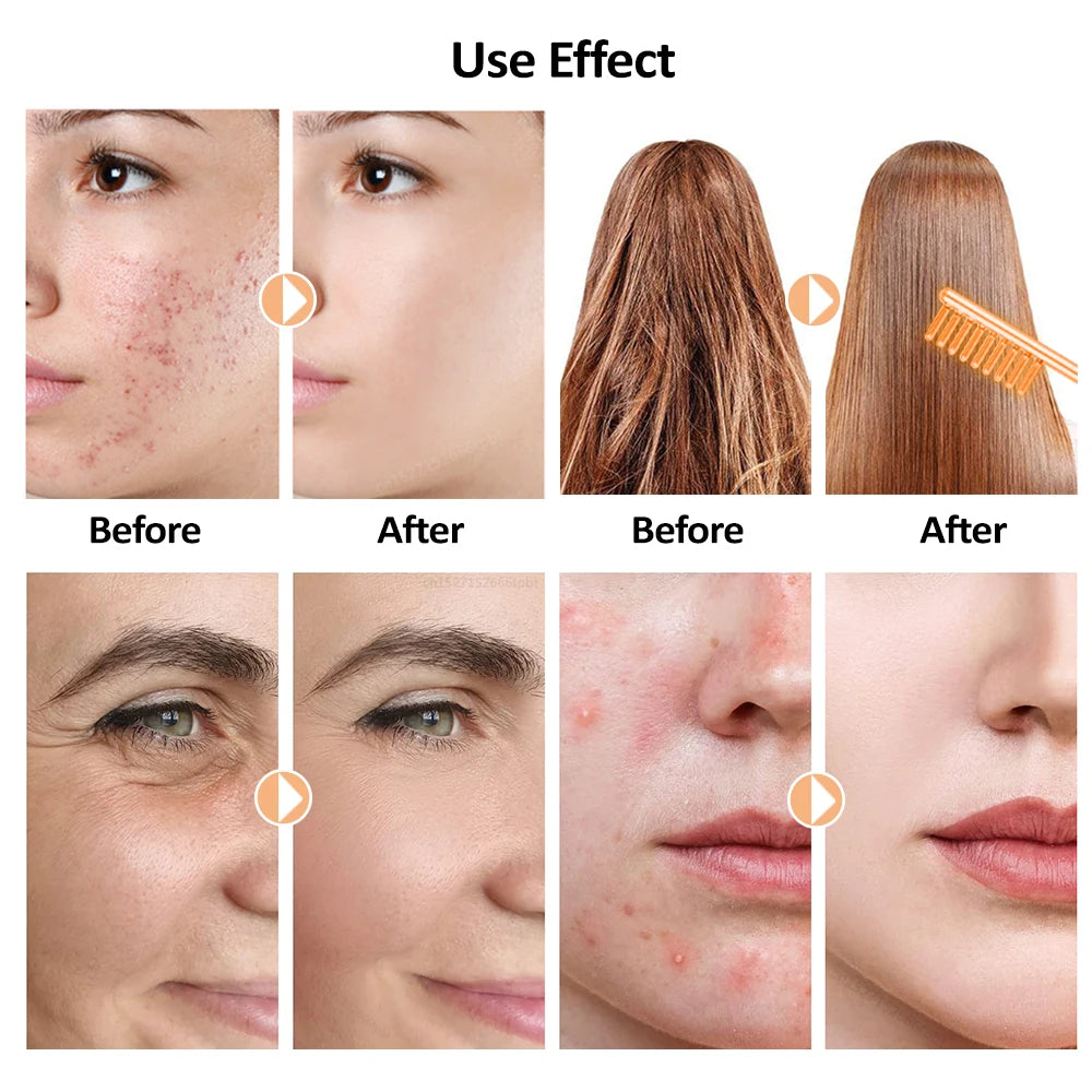 KentDO™ High Frequency Wand for Acne & Skin Tightening