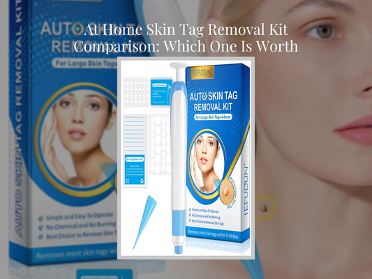 At Home Skin Tag Removal Kit Comparison: Which One Is Worth Buying