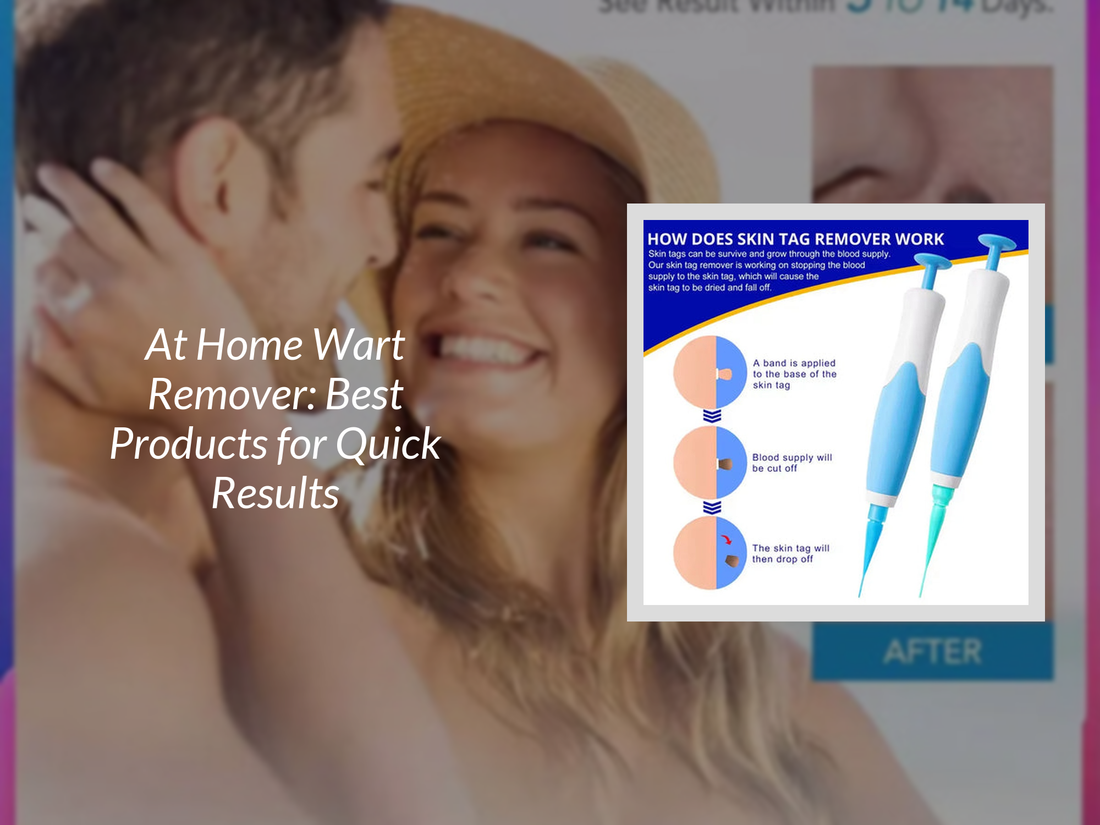 At Home Wart Remover: Best Products for Quick Results