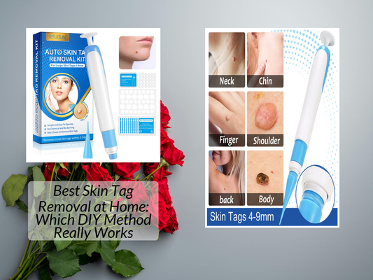 Best Skin Tag Removal at Home: Which DIY Method Really Works