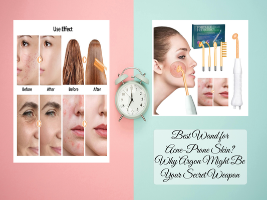 Best Wand for Acne-Prone Skin? Why Argon Might Be Your Secret Weapon