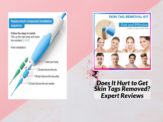 Does It Hurt to Get Skin Tags Removed? Expert Reviews