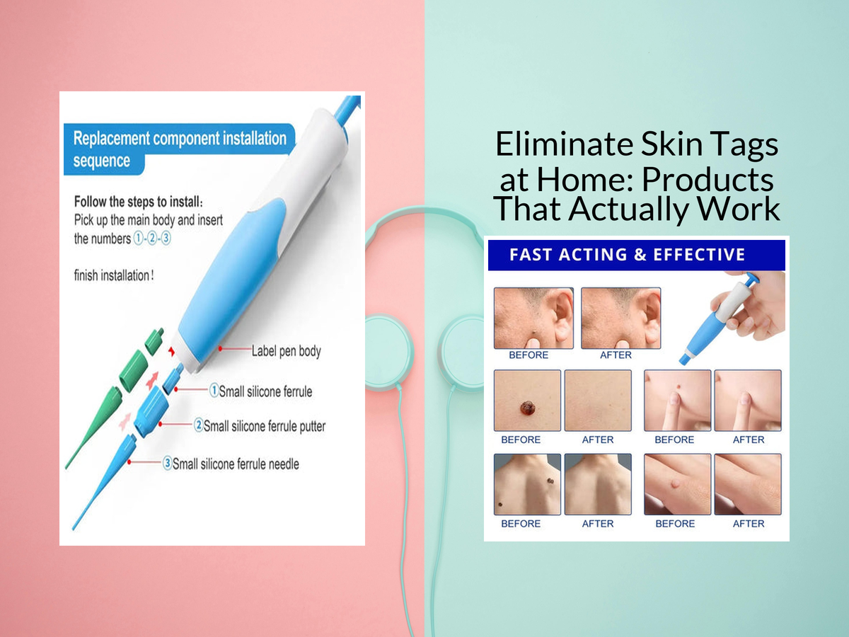 Eliminate Skin Tags at Home: Products That Actually Work – KentDO ...