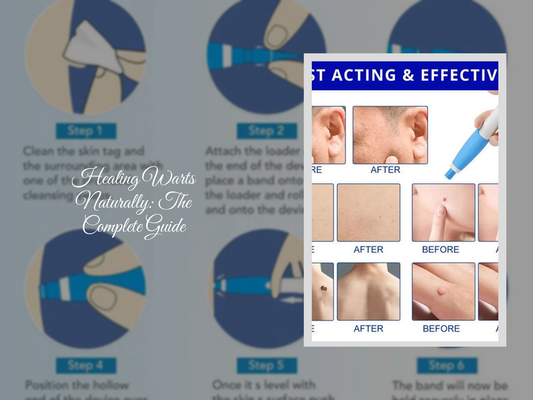 Healing Warts Naturally: The Complete Guide