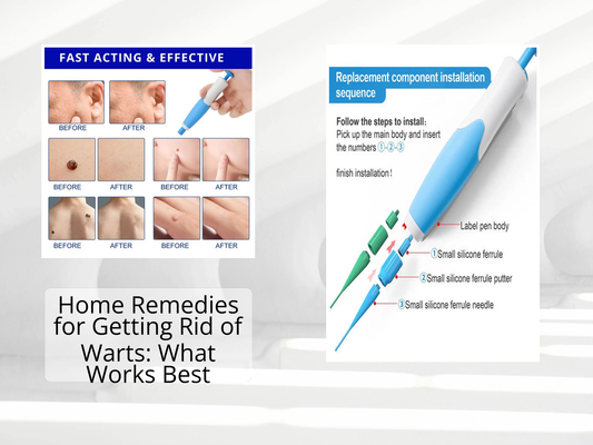 Home Remedies for Getting Rid of Warts: What Works Best