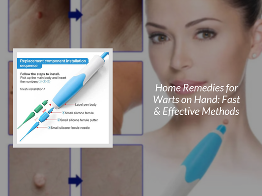 Home Remedies for Warts on Hand: Fast & Effective Methods