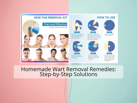 Homemade Wart Removal Remedies: Step-by-Step Solutions
