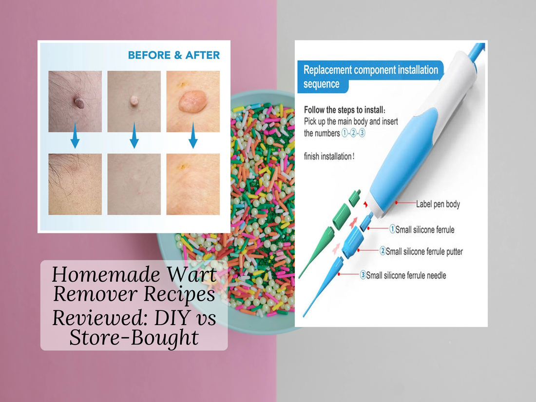 Homemade Wart Remover Recipes Reviewed: DIY vs Store-Bought