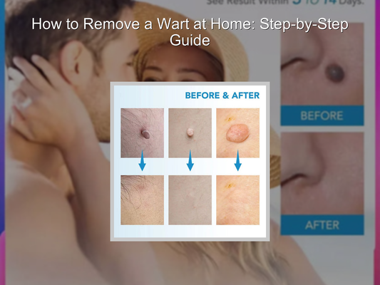 How to Remove a Wart at Home: Step-by-Step Guide