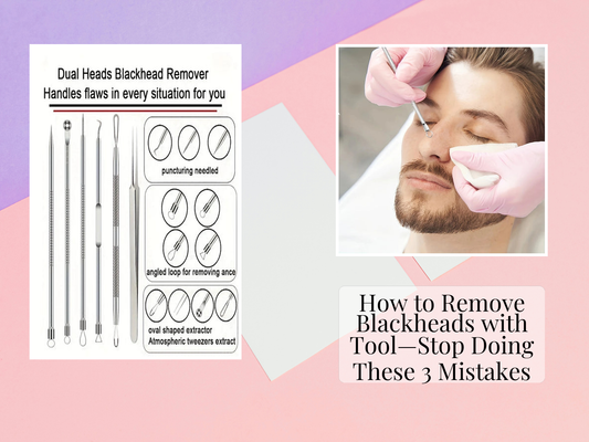 How to Remove Blackheads with Tool—Stop Doing These 3 Mistakes