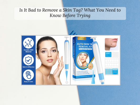 Is It Bad to Remove a Skin Tag? What You Need to Know Before Trying