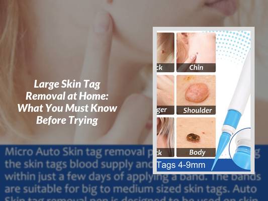 Large Skin Tag Removal at Home: What You Must Know Before Trying