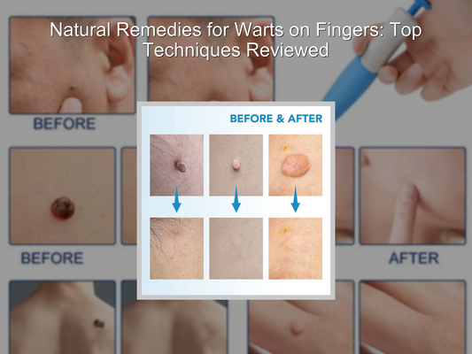 Natural Remedies for Warts on Fingers: Top Techniques Reviewed