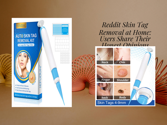 Reddit Skin Tag Removal at Home: Users Share Their Honest Opinions