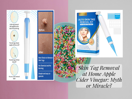 Skin Tag Removal at Home Apple Cider Vinegar: Myth or Miracle?
