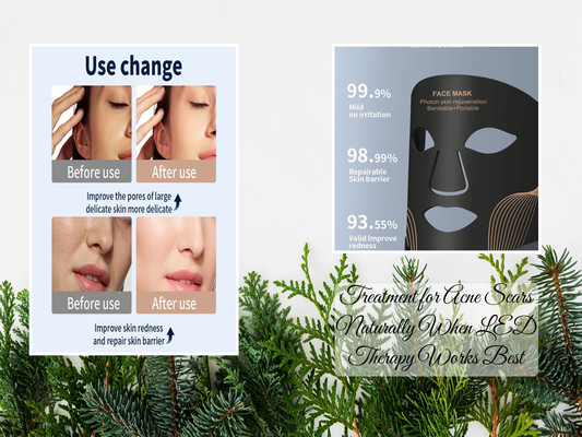 Treatment for Acne Scars Naturally When LED Therapy Works Best