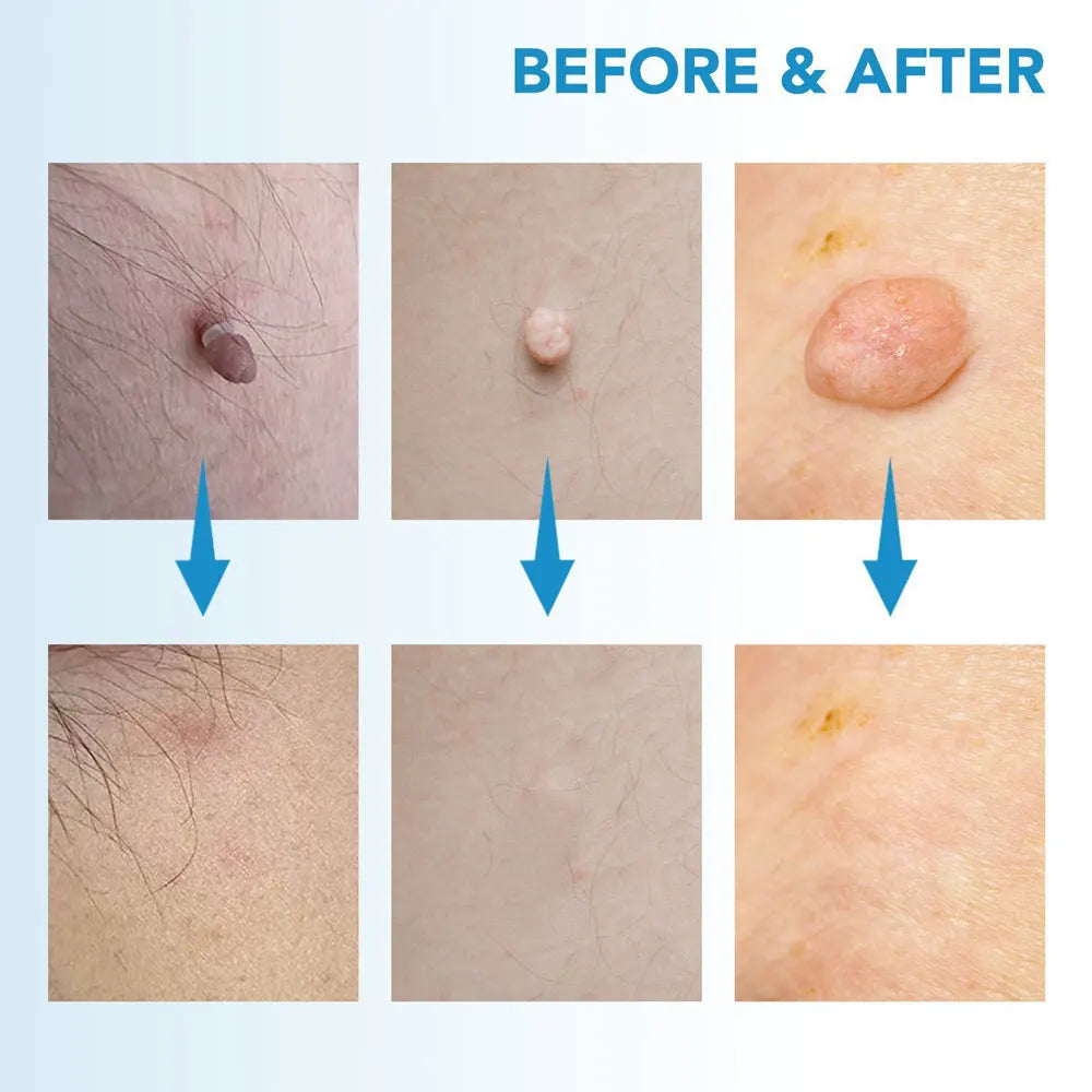 does it hurt to get skin tags removed - KentDO
