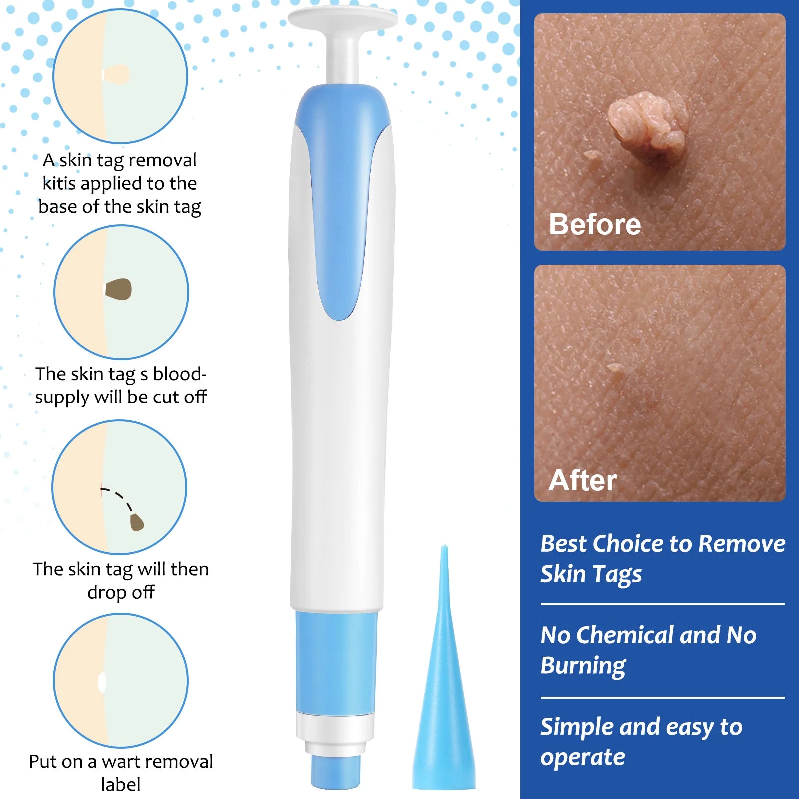 reddit skin tag removal at home - KentDO