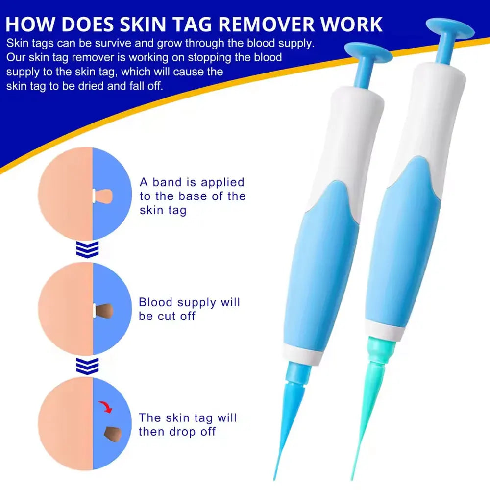 skin tag removal at home remedies - KentDO