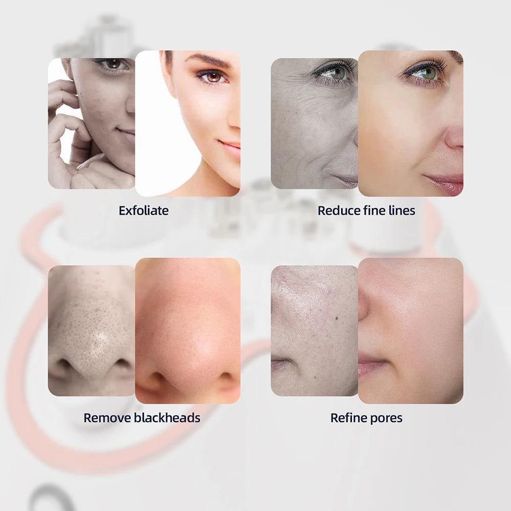 KentDO™ Diamond Microdermabrasion Machine for Smooth Skin