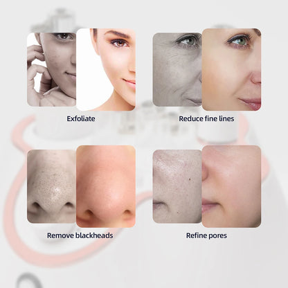 KentDO™ Diamond Microdermabrasion Machine for Smooth Skin