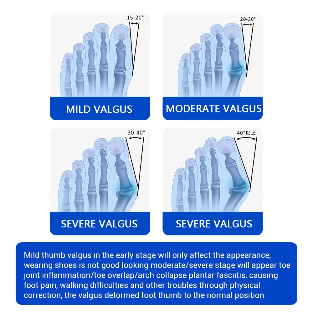 KentDO™ Bunion Corrector Toe Separator for Pain Relief