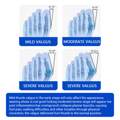 KentDO™ Bunion Corrector Toe Separator for Pain Relief