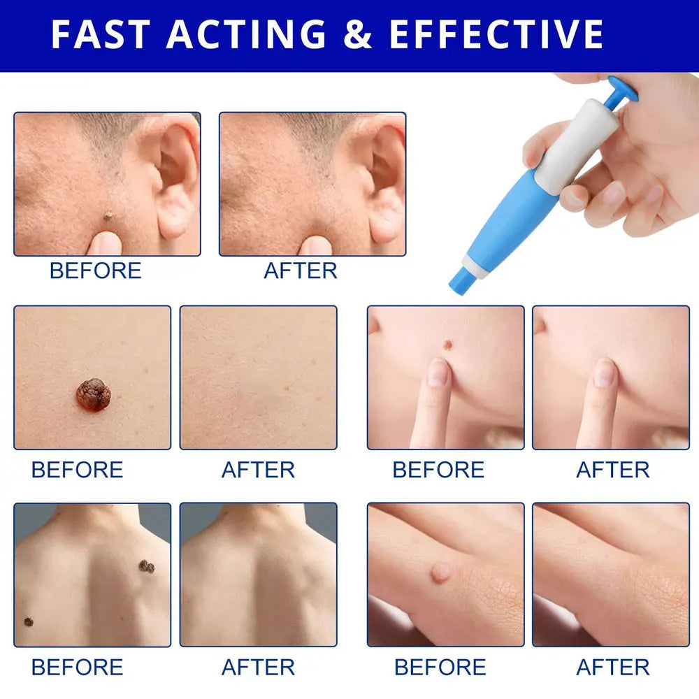 KentDO™ Double Head Wart Remover Pen – Safe Skin Tag Removal
