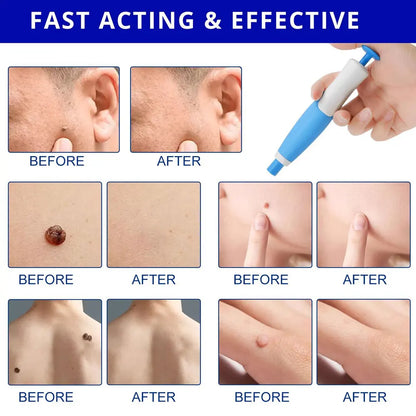 KentDO™ Double Head Wart Remover Pen – Safe Skin Tag Removal