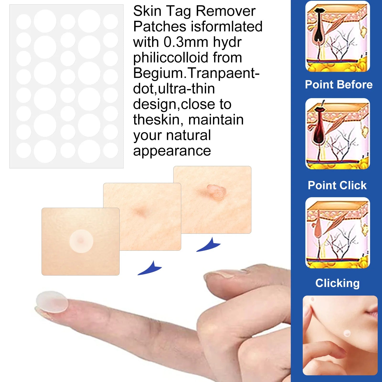 at home skin tag removal kit - KentDO