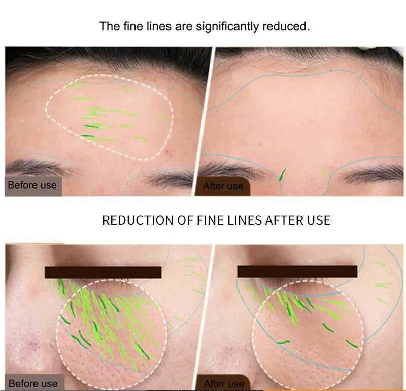 KentDO™ EMS RF Facial & Body Machine | Skin Tightening