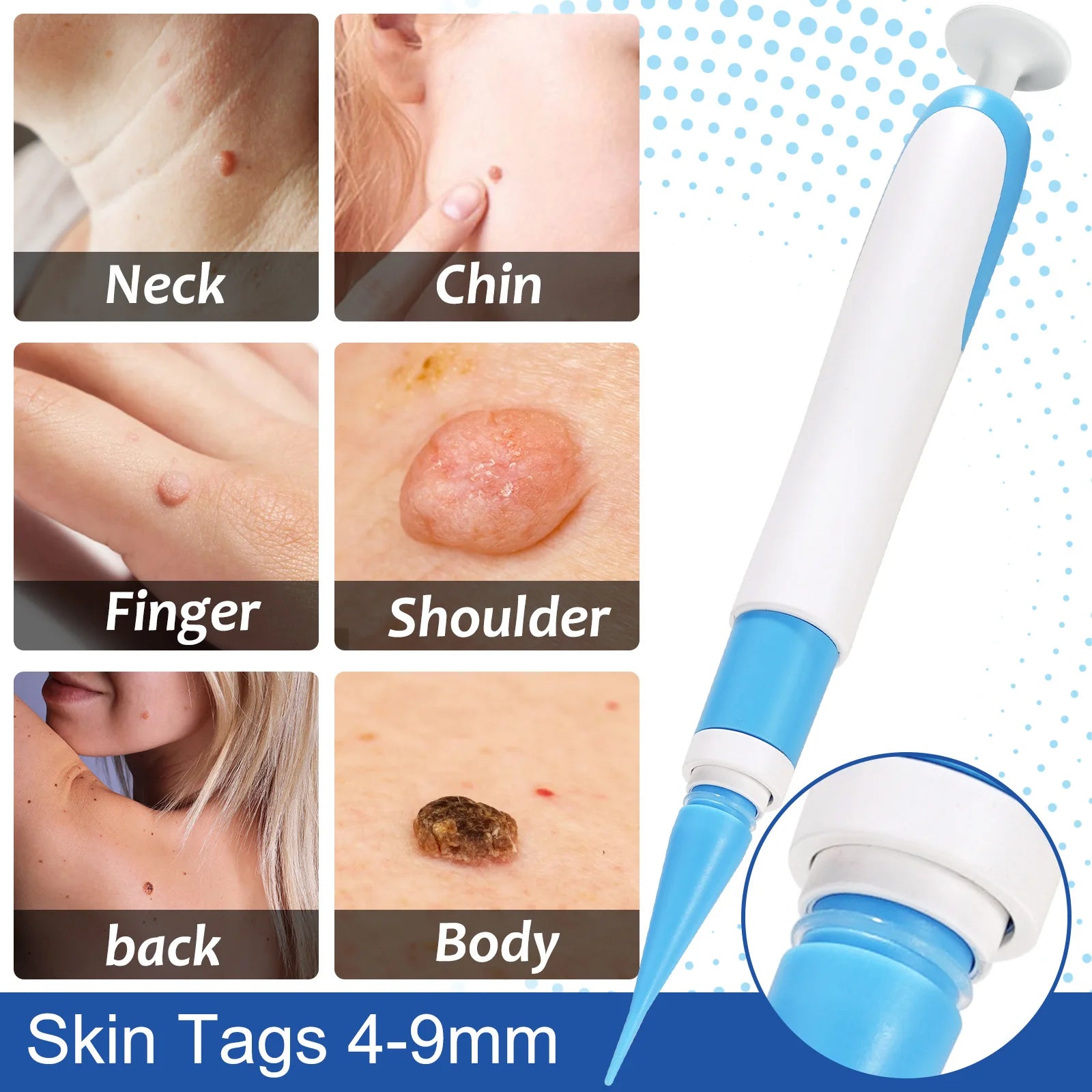 painless removal of skin tags - KentDO